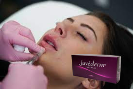 2 * 1 ml Juvederm Ultra 3 Lip Filler Hyaluronic Acid Gel Fillers