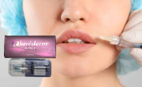 2 * 1 ml Juvederm Ultra 3 Lip Filler Hyaluronic Acid Gel Fillers