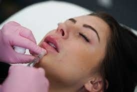GMP Juvederm Ultra 3 HA Wypełniacz skórny do ust Juvederm Vollure
